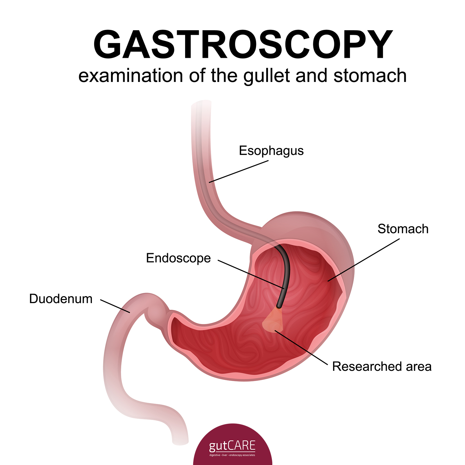 Gastroscopy (Upper GI Endoscopy)| Singapore| Cost | gutCARE