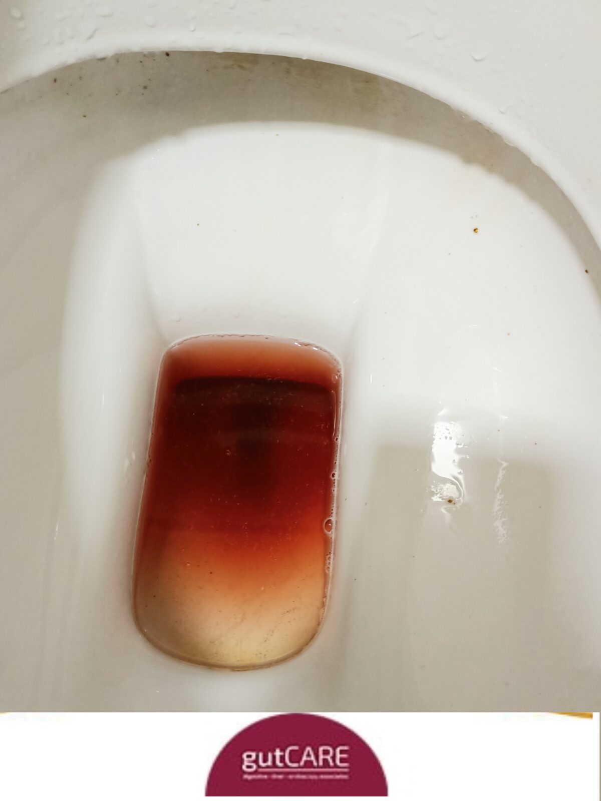 大便出血:是痔疮还是癌症的征兆? | gutCARE