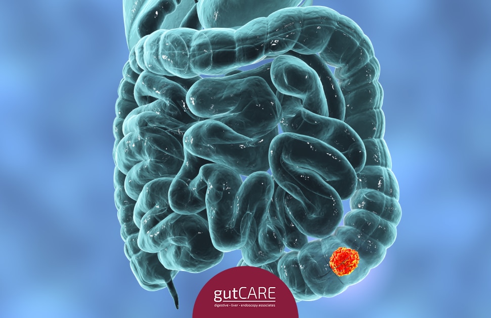 Colorectal Cancer Treatment: Know The Options You Have