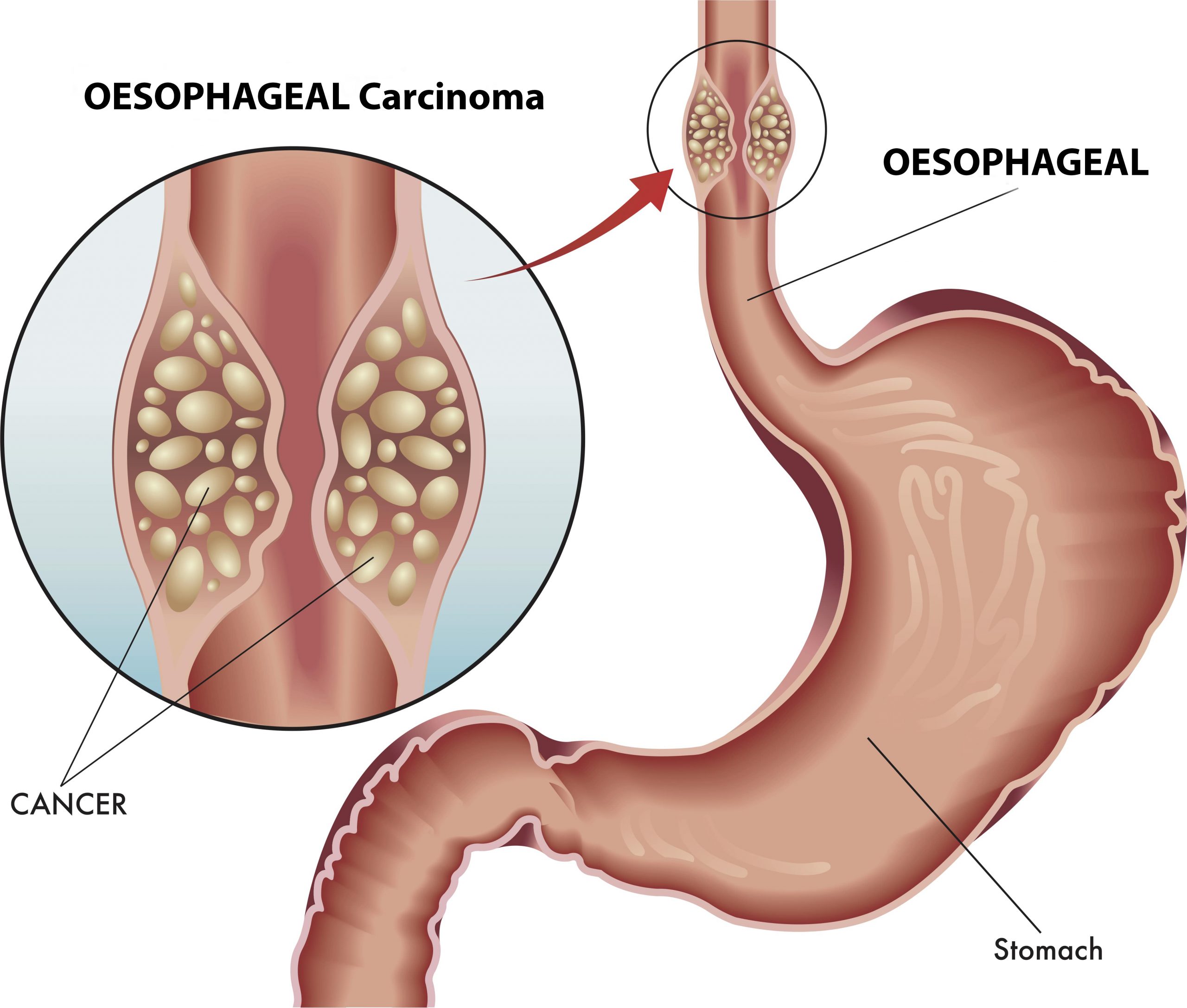 Stomach Cancer and Esophageal Cancer