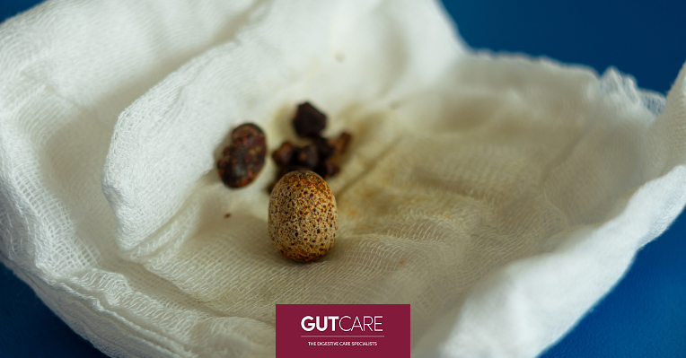 All You Need To Know About Gallstones And How To Avoid Them